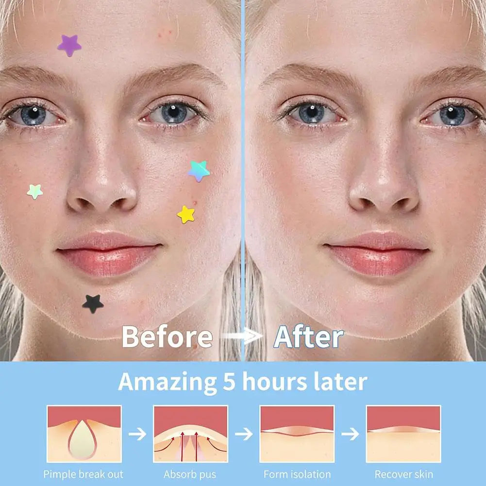 Colorful Star Acne Patch